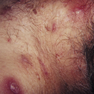 Hidradenitis suppurativa – en plagsom hudsykdom