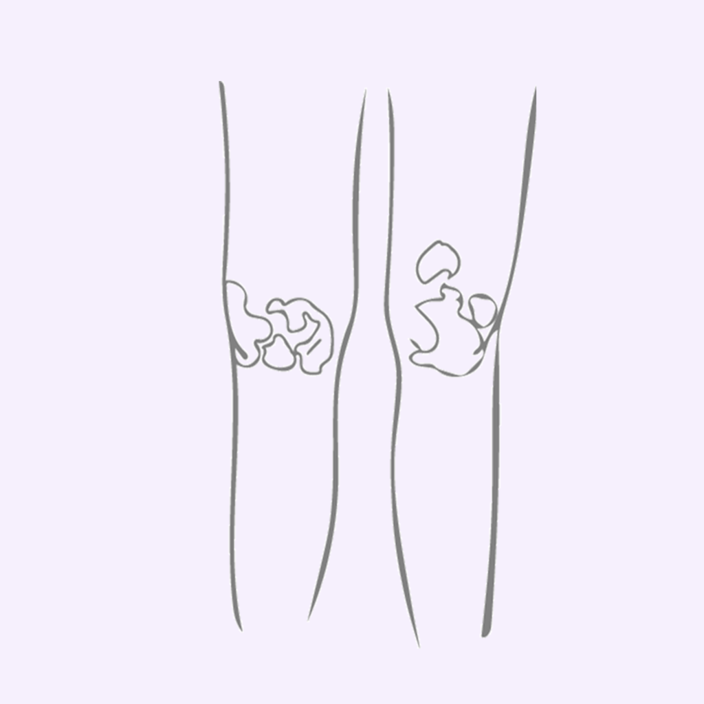 illustrasjon knær med utslett