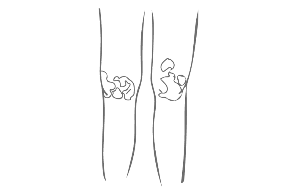 illustrasjon knær med utslett
